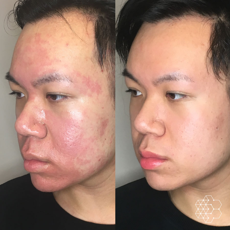 Microneedling