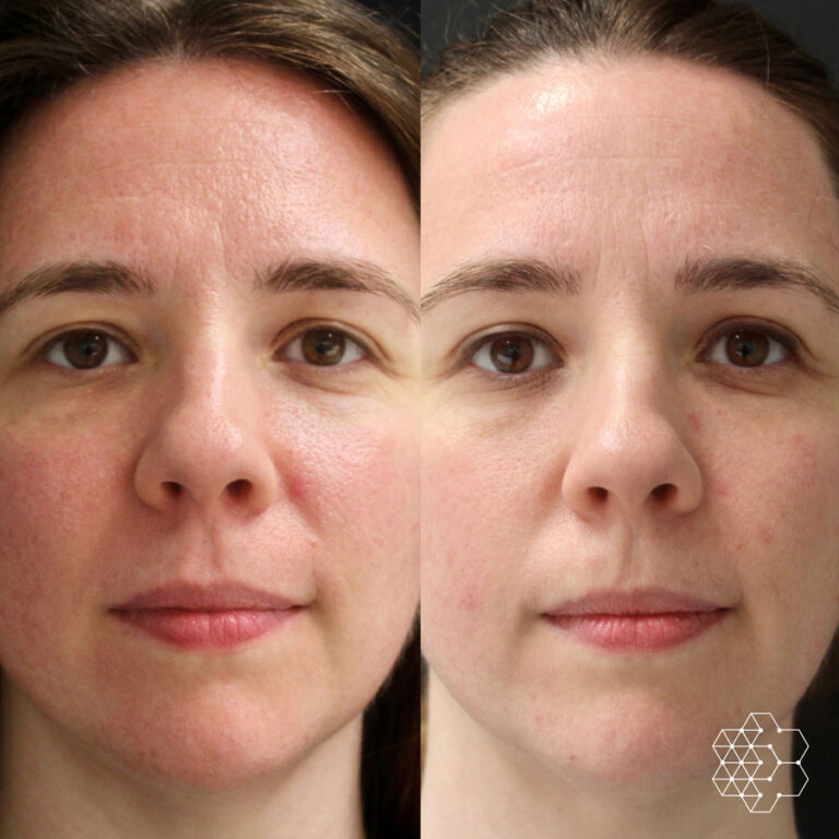 rosacea