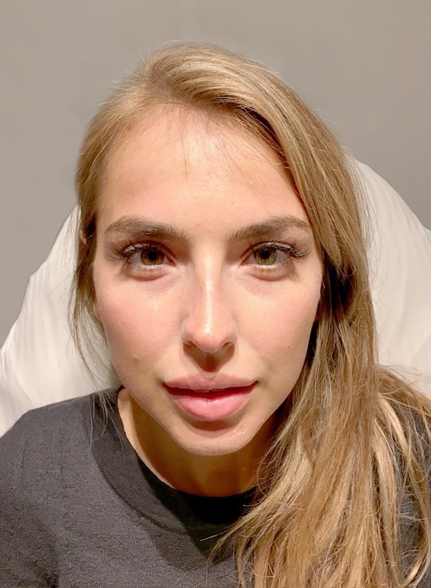 Forehead Lines Correction