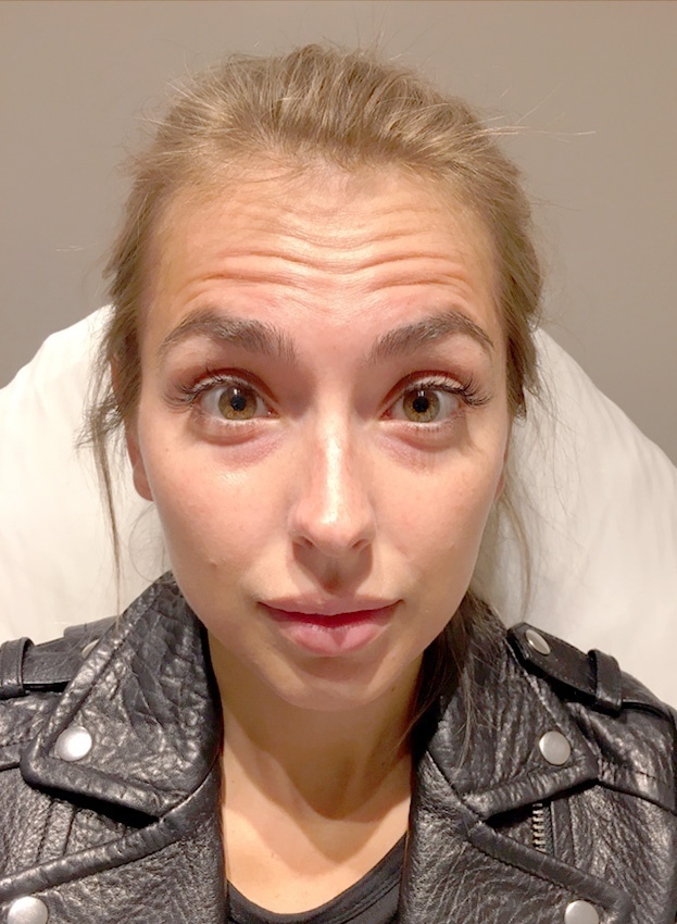 Forehead Lines Correction