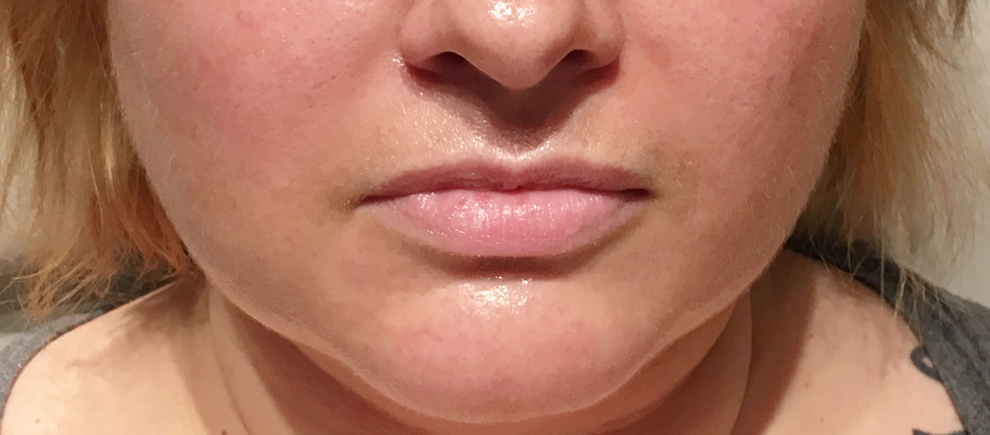 Lip Fillers Vancouver