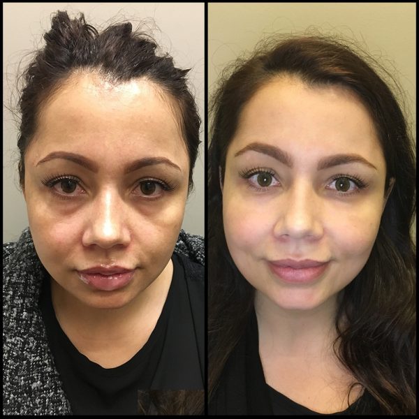 Facial Fillers Vancouver