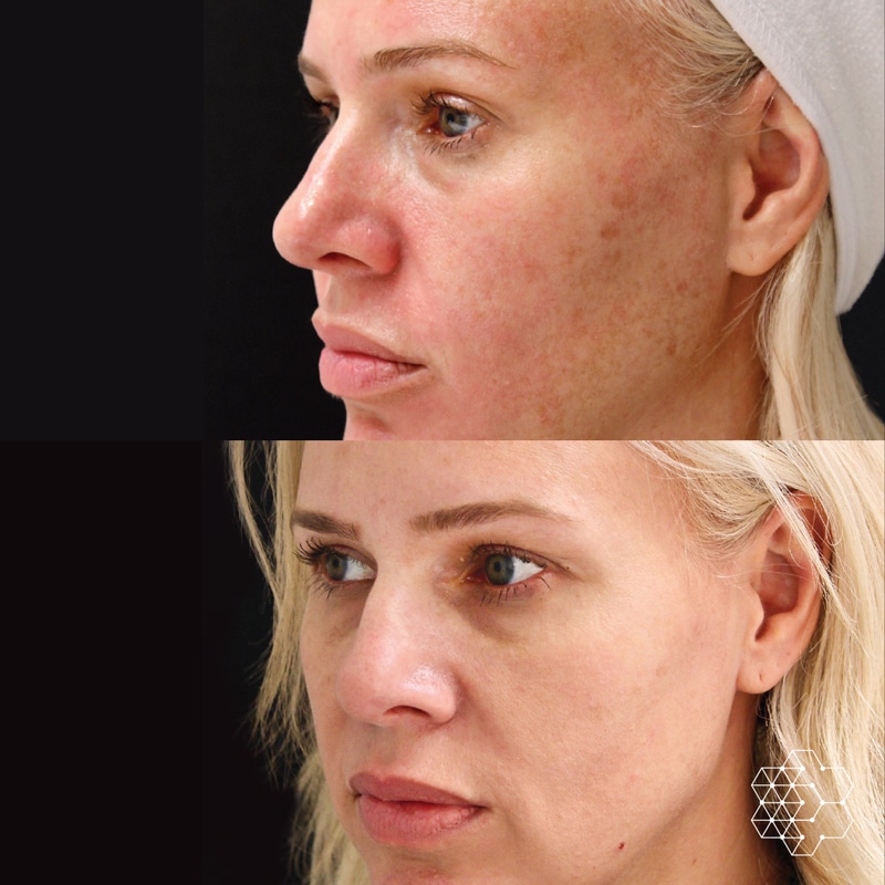 Before and after image of microneedling treatment