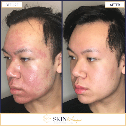 microneedling for acne vancouver