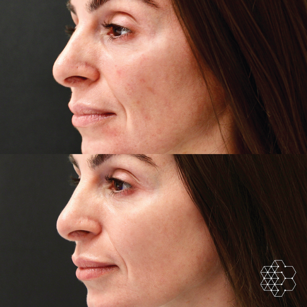 Before and after image of Forever Young BBL treatment showing reduction in blemishes