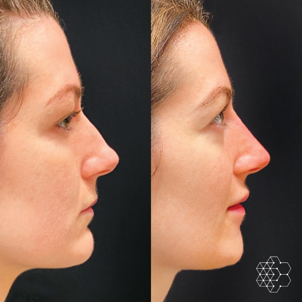 Non-Surgical Rhinoplasty (Liquid Rhinoplasty) In Vancouver, BC