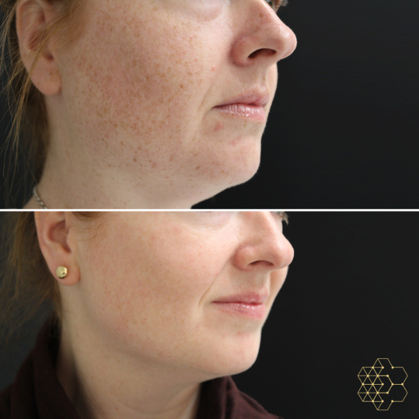 Before and after image of Forever Young BBL treatment showing rejuvenated skin