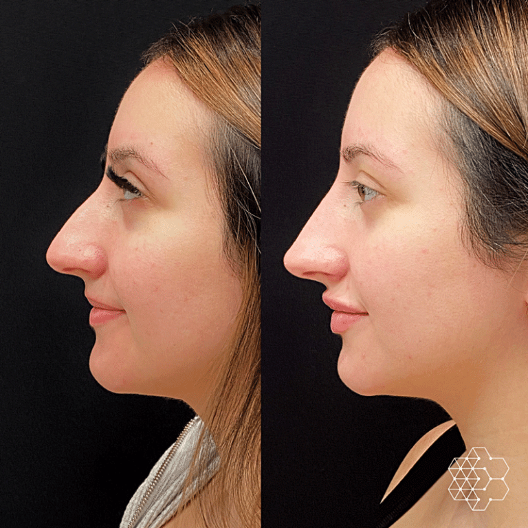 Non-Surgical Nose Job Vancouver, BC - Non Surgical Rhinoplasty