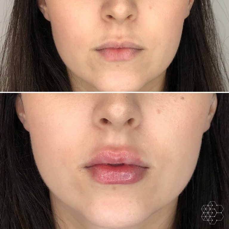 Lip Injections in Vancouver, BC | Lip Enhancement Technique