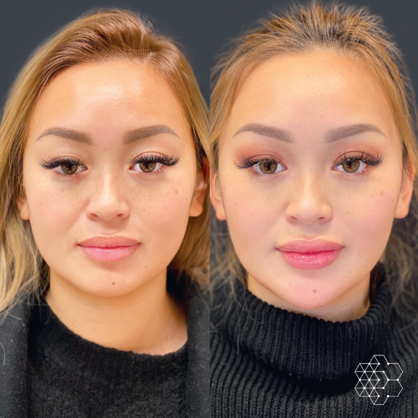 Before And After Sized For Skin Technique 23 