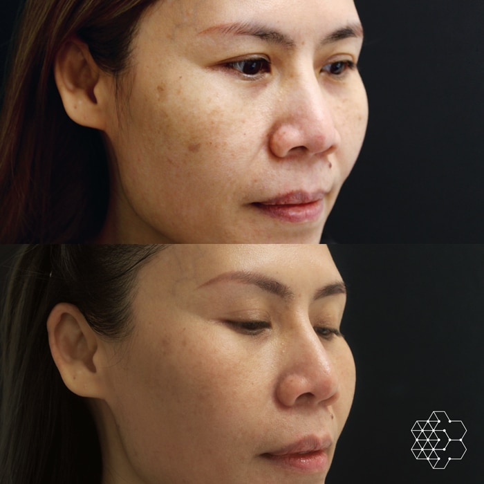 HALO™ Laser Skin Resurfacing Treatment Vancouver | Skin Technique