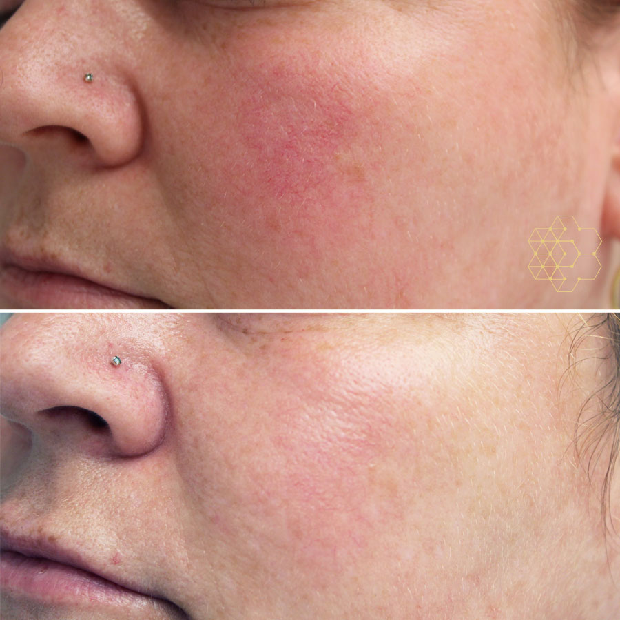 rosacea cheeks treatment