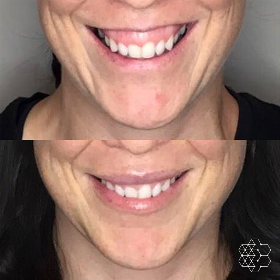 How To Fix A Gummy Smile With Botox 3 As a neurotoxin