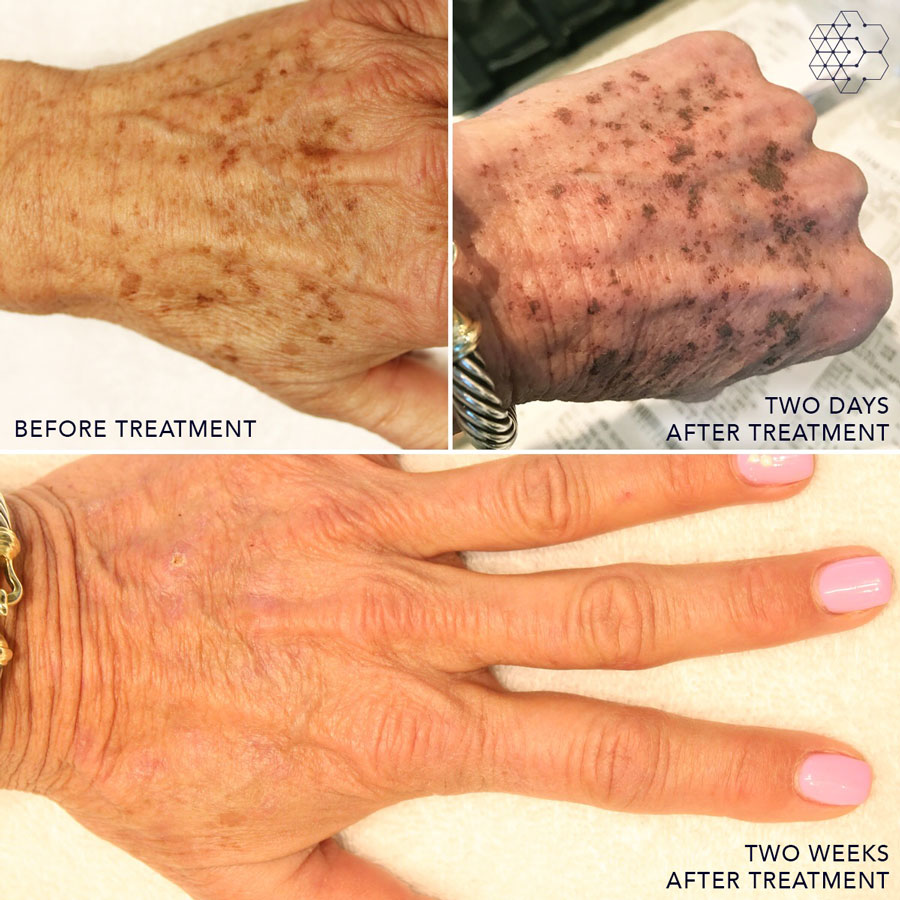 Aging Hands Skin Treatment in Vancouver, BC