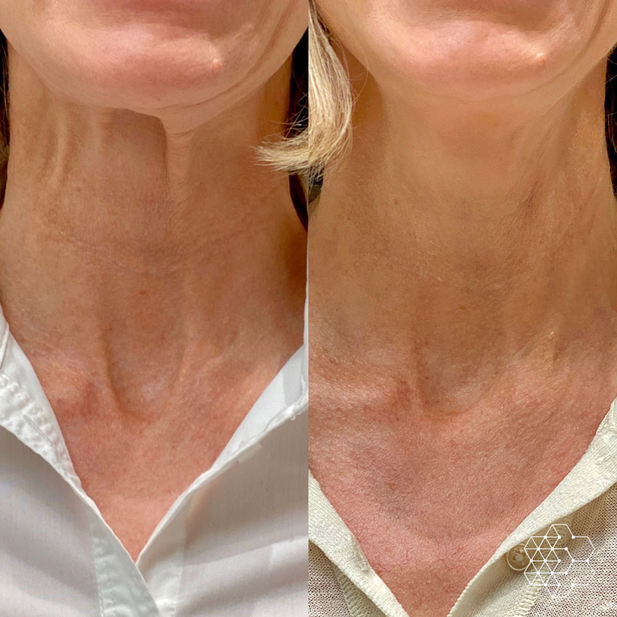 Neck Lines and Laxity Treatments in Vancouver | Skin Technique