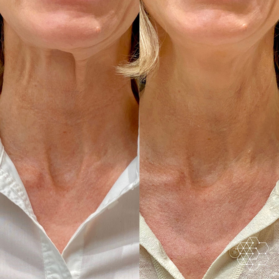 Neck Lines and Laxity Treatments in Vancouver Skin Technique