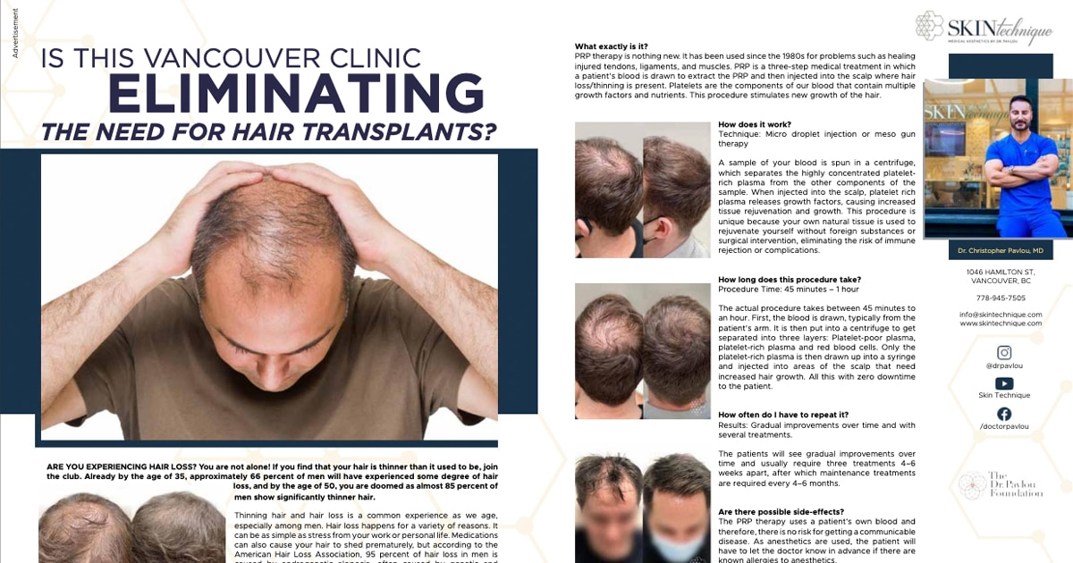 Non-Invasive Alternatives to Hair Transplant | Skin Technique