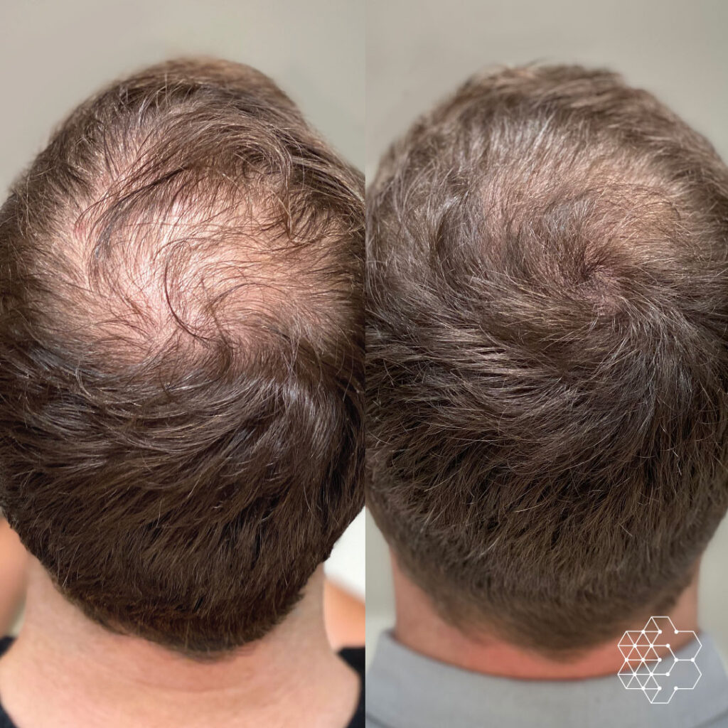 Why Is Prp Hair Therapy More Effective Than Others