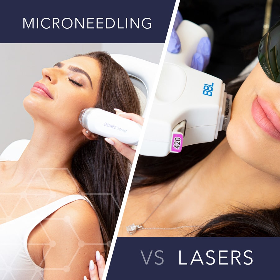 Microneedling vs Lasers Treatments Vancouver Skin Technique