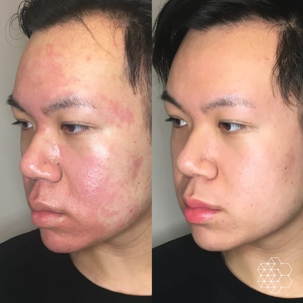 Microneedling before & after photos