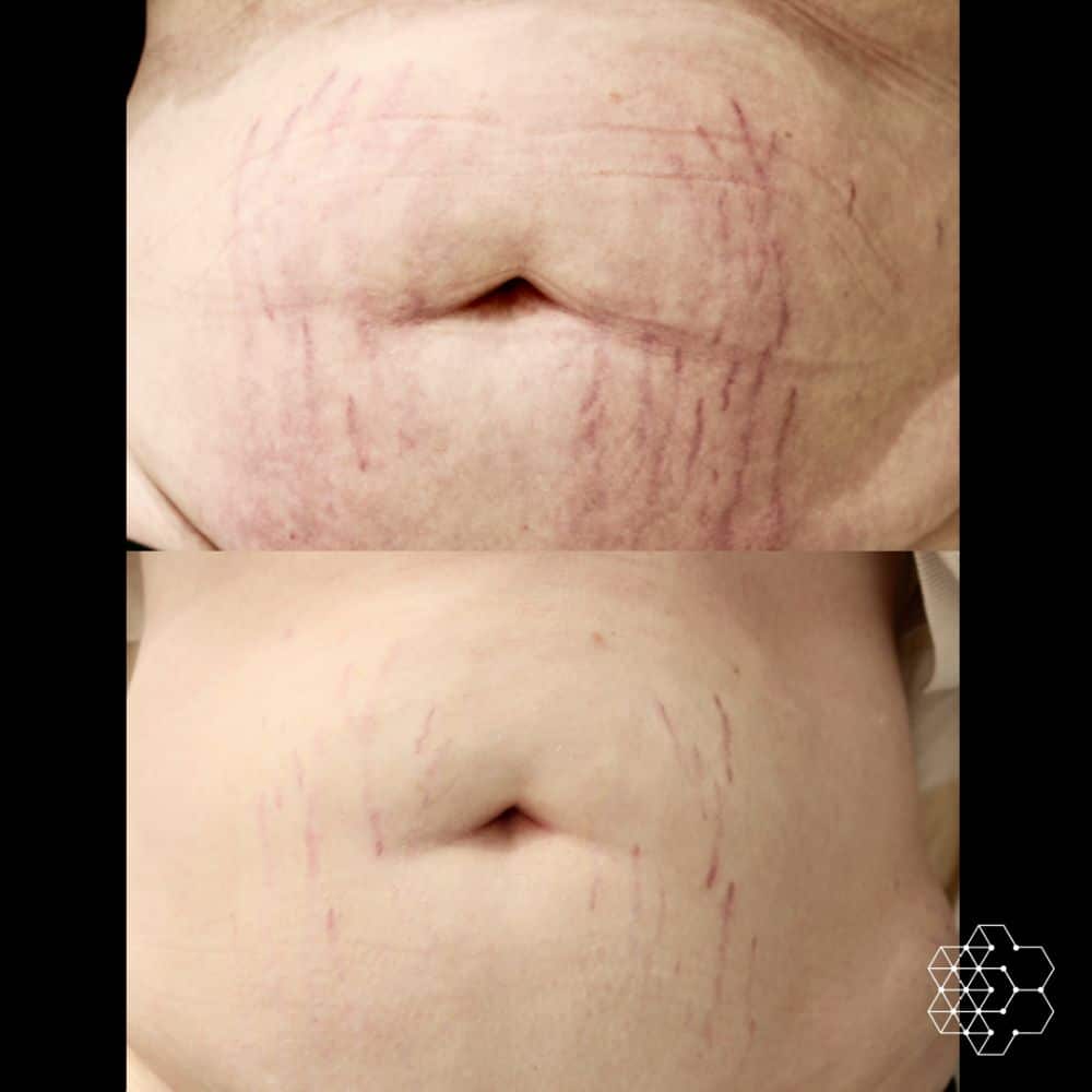 Let's Talk about Laser Stretch Mark Removal Treatment