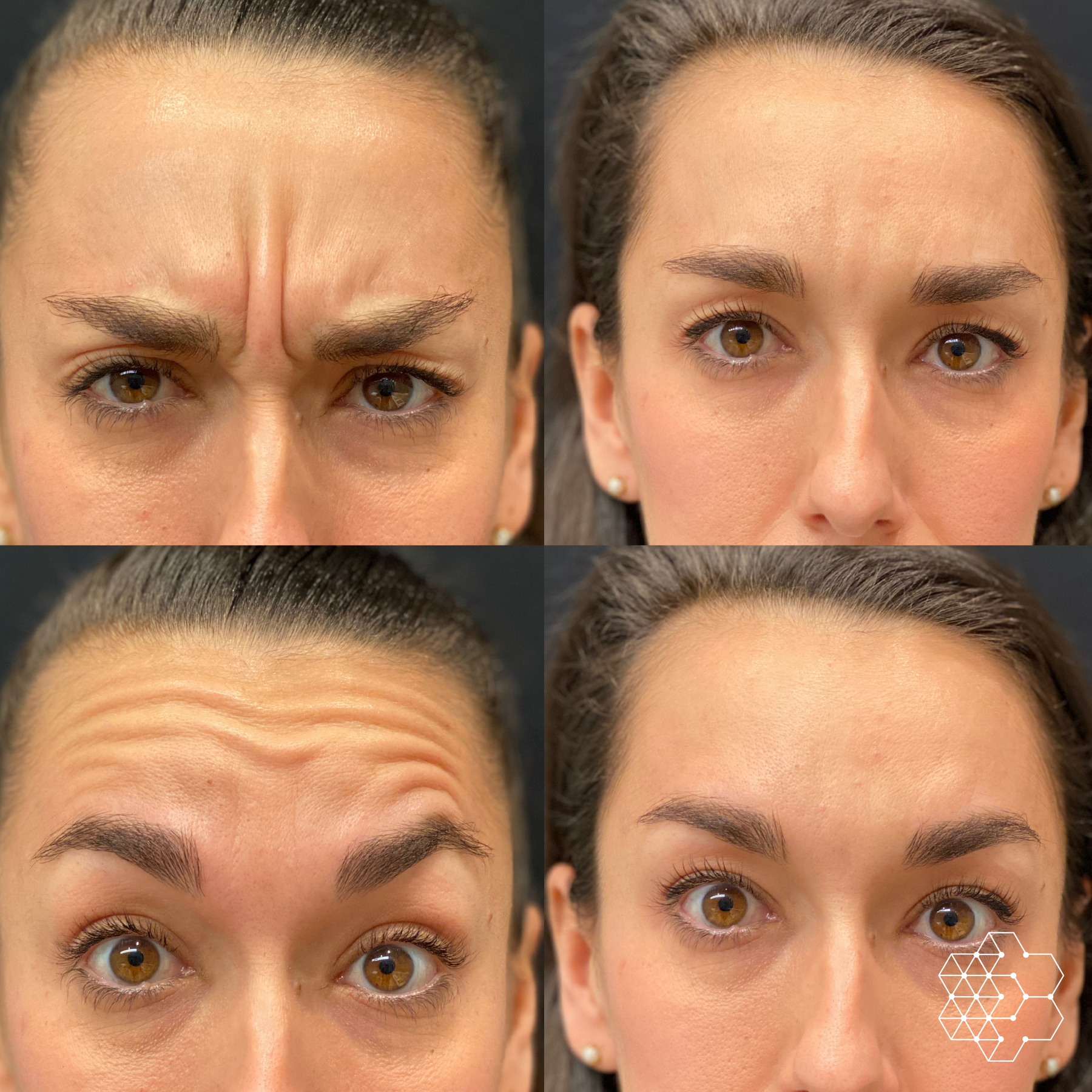 Top 5 Facial Areas for Botox Treatments