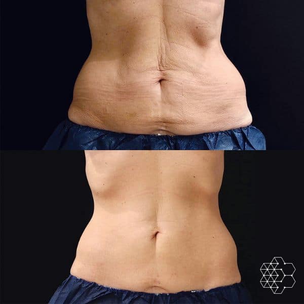What Areas Can You Have Treated with CoolSculpting®