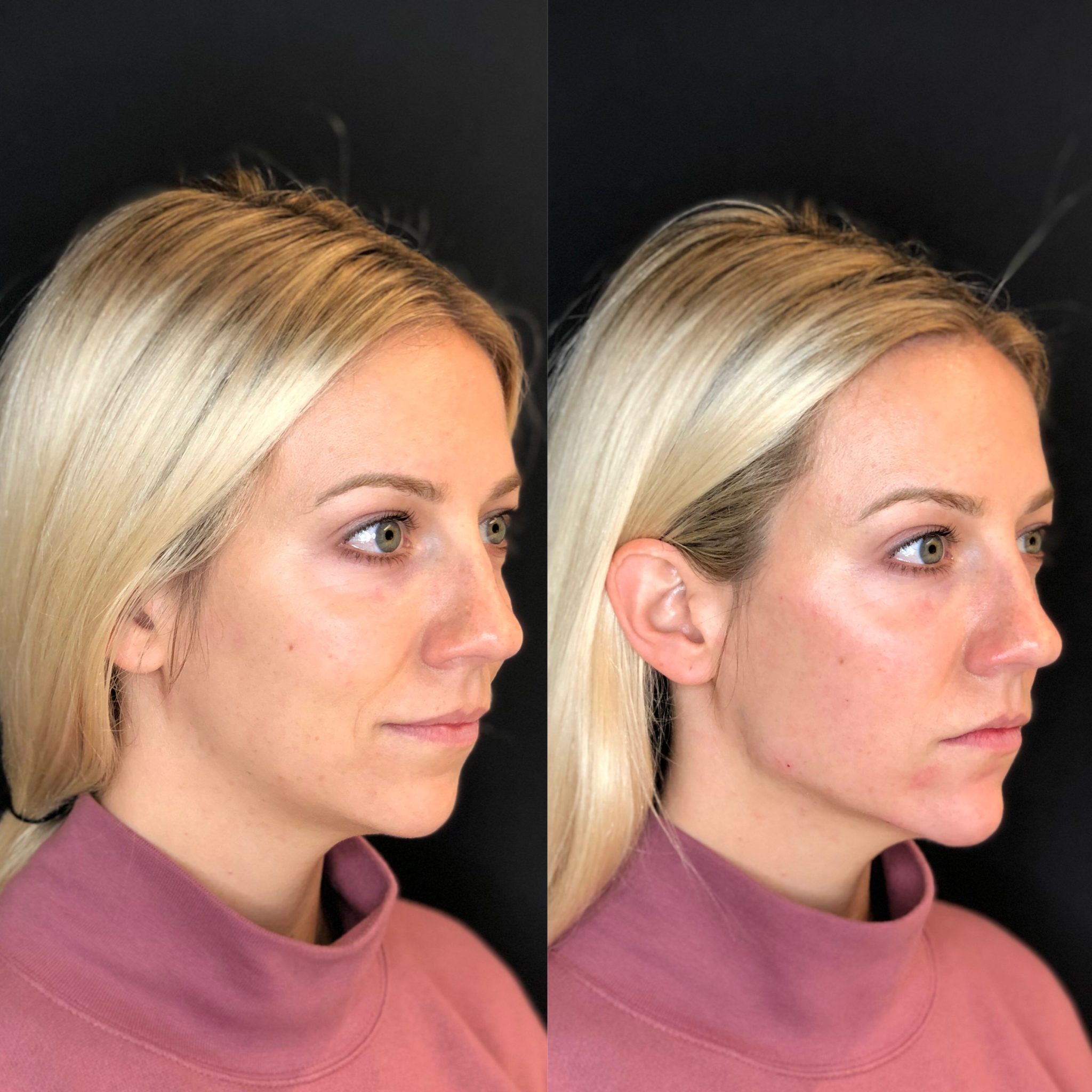 Get A Chiseled Jawline Without Surgery Skin Technique