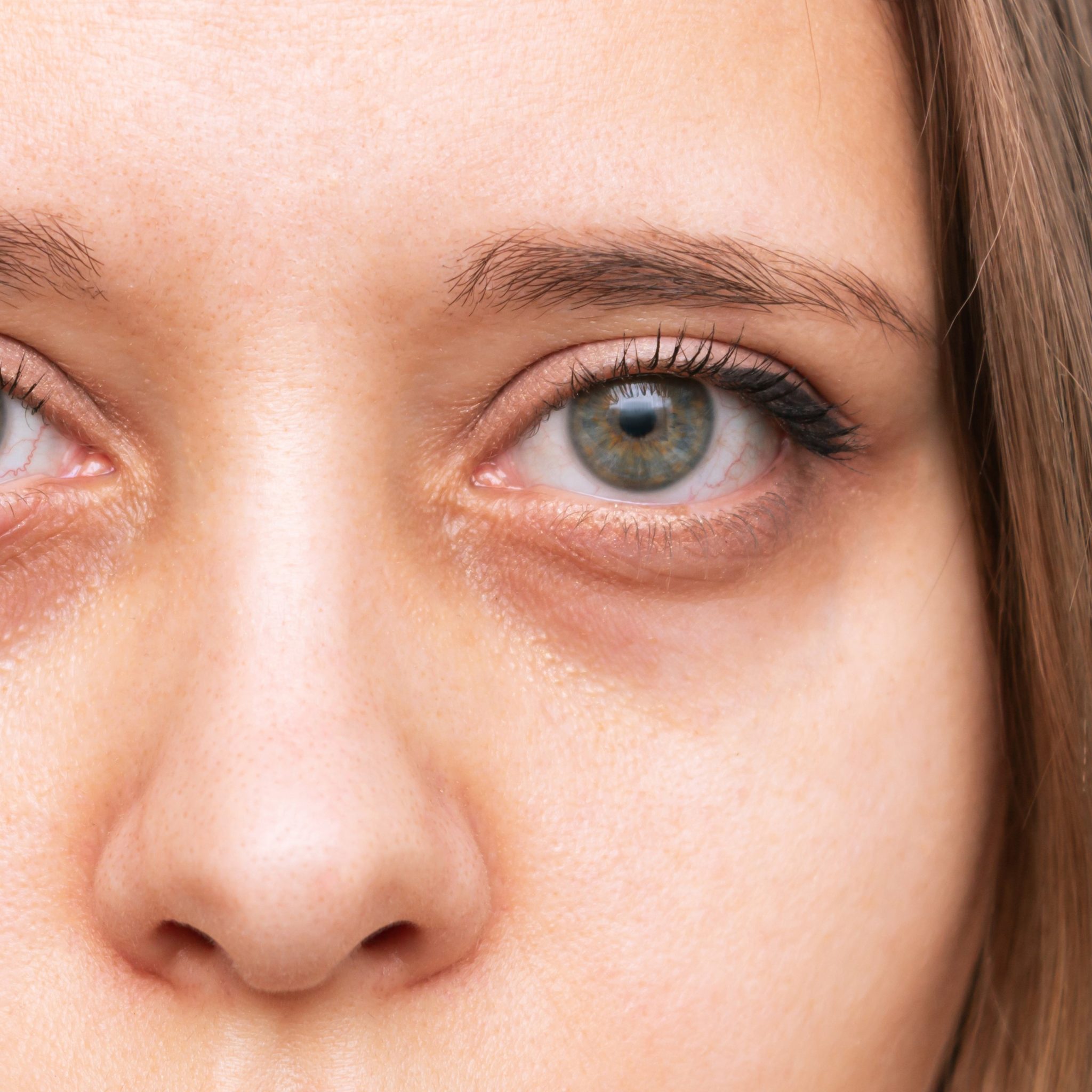 Dark Circles Around Eyes Cause of Hyperpigmentation