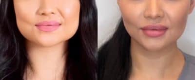 masseter muscle botox before and after