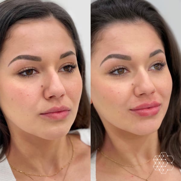 lip fillers before and after vancouver