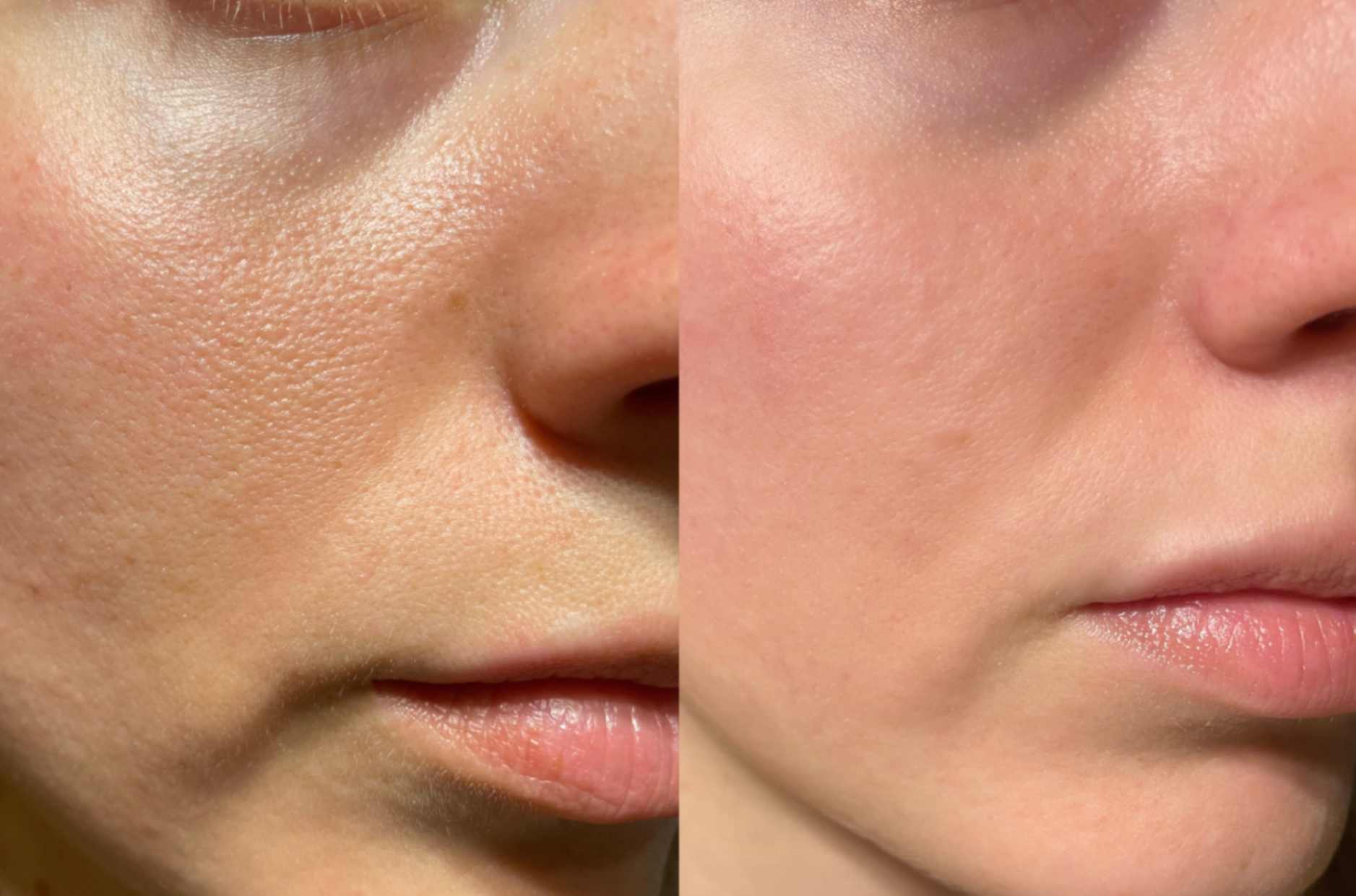 Microneedling before and after