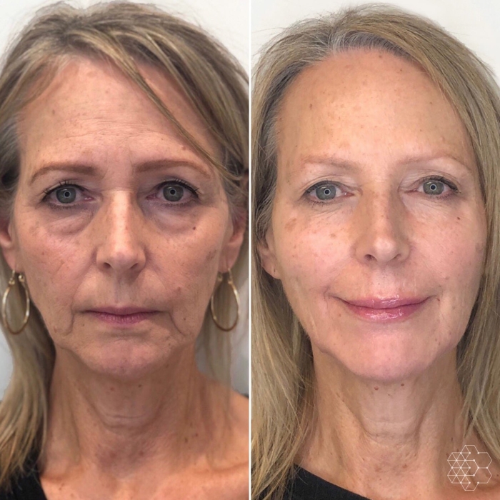 Liquid Face Lift Vancouver using strategic injections of botox and filler to restore a youthful appearance