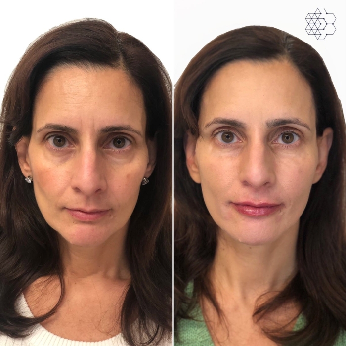 Liquid Face Lift Vancouver using a combination of non surgical injections such as botox and filler