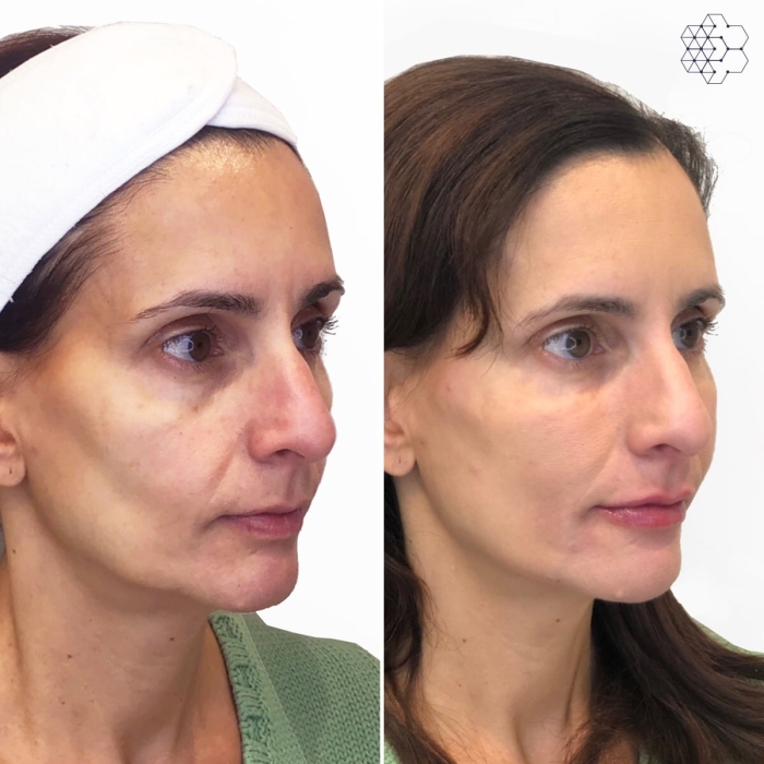 Liquid Face Lift Vancouver procedure using botox and fillers